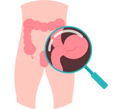 Cirugía de Hernia en Irapuato