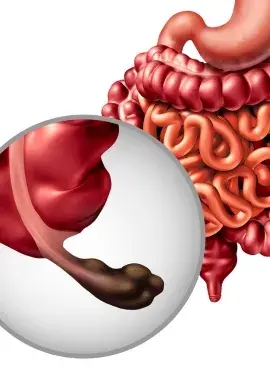 Apendicitis Apendicetomía en Irapuato