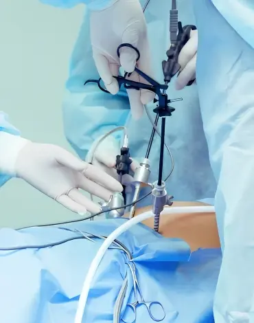Cirugía de Hernia Umbilical en Irapuato