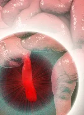 Inflamacion-De-Apéndice Apendicetomía en Irapuato