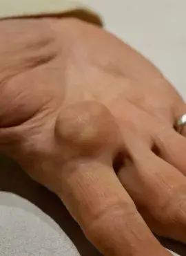 Que-pasa-si-no-me-quito-el-lipoma Cirugía de Lipomas en Irapuato