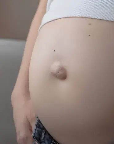 Cirugía de Hernia Umbilical en Irapuato