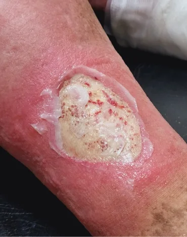 Cirugía de Heridas Complejas en Irapuato