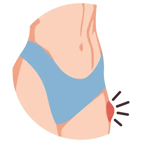 Cirugía de Hernia en Irapuato
