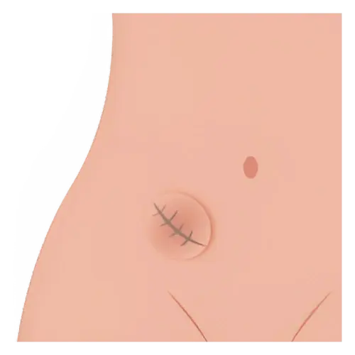 Cirugía de Hernia en Irapuato