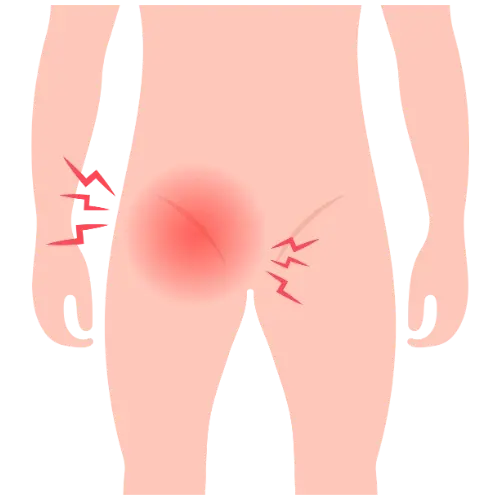 Cirugía de Hernia en Irapuato