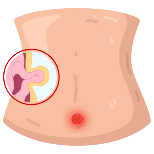 Cirugía de Hernia en Irapuato